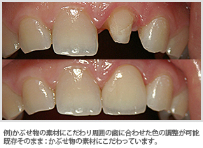 矯正用器具にこだわっています。